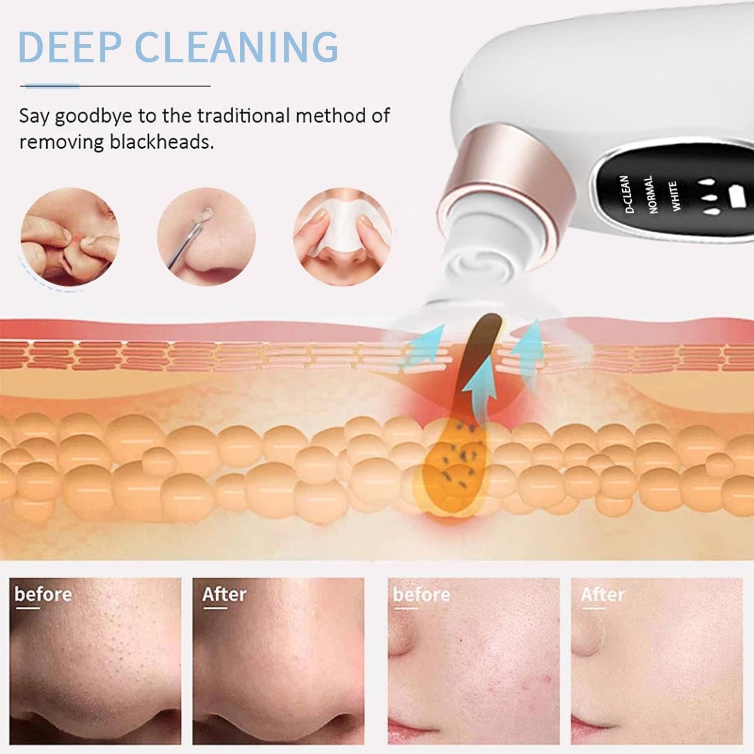 blackhead remover blackhead remover